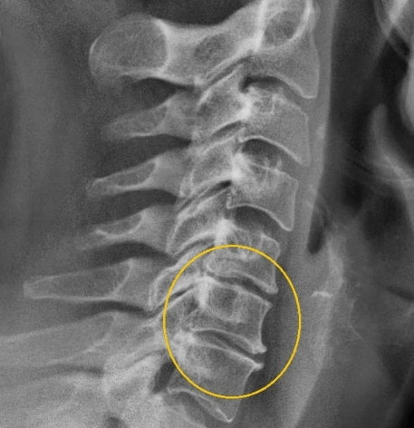 cervikálna osteochondróza